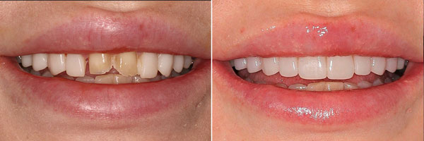 natural-looking veneers