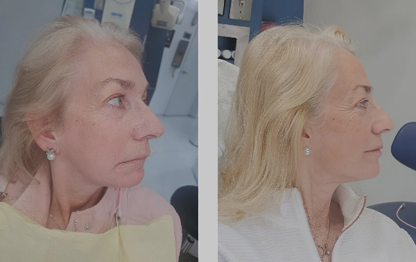 Facial Harmony Veneers