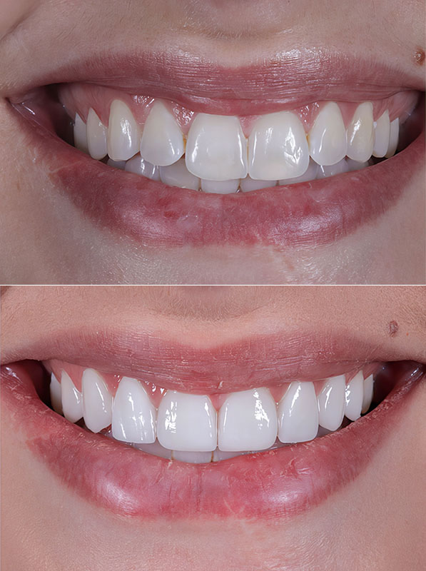 Veneers Translucency - Before and After